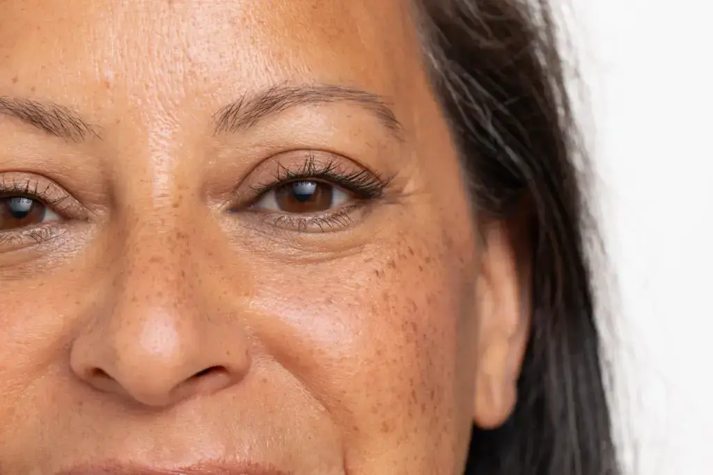 Sculptra results, gradual natural facial volume restoration, Augusta, GA